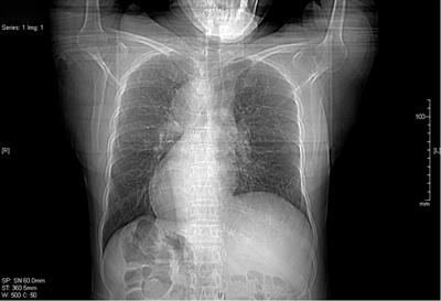 Case Report: Rare Dynein Axonemal Heavy Chain 9 Mutations in a Han-Chinese Patient With Kartagener Syndrome